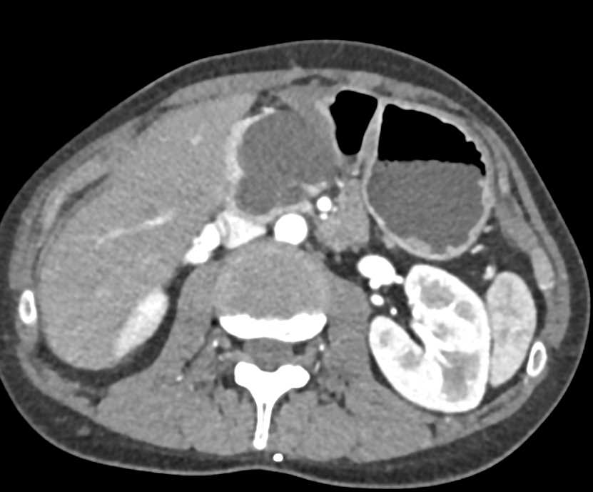 Serous Cystadenoma Head of Pancreas - CTisus CT Scan