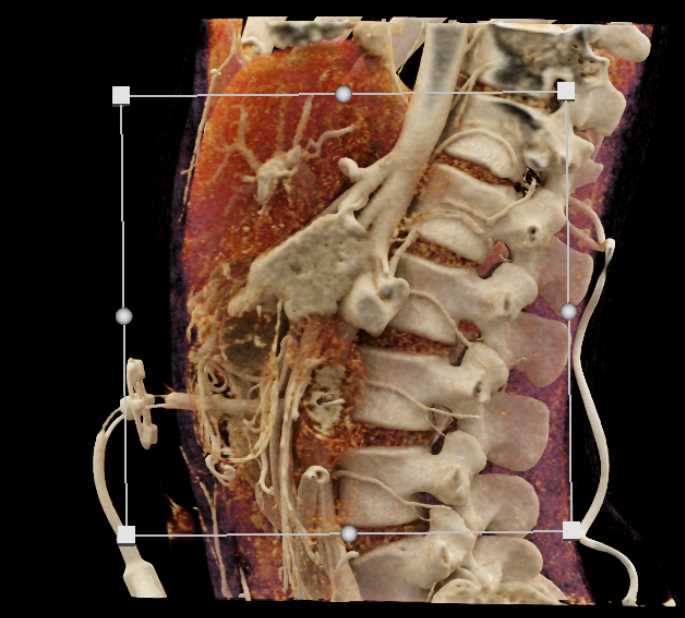 Serous Cystadenoma Head of Pancreas with Cinematic Rendering - CTisus CT Scan