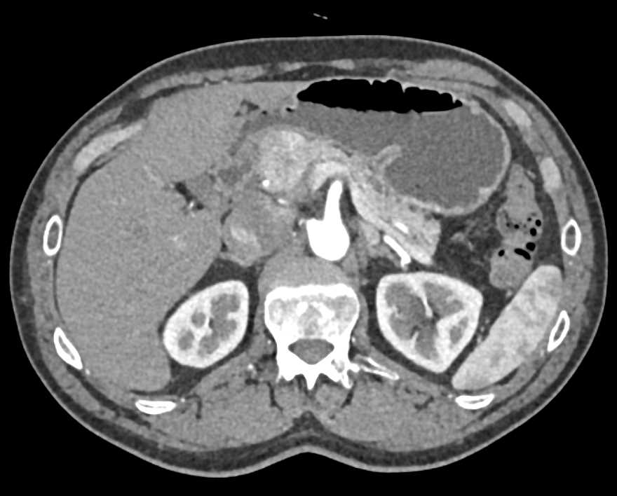 Carcinoma Head of Pancreas - CTisus CT Scan