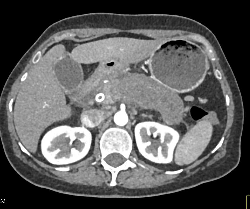 Autoimmune Pancreatitis - CTisus CT Scan