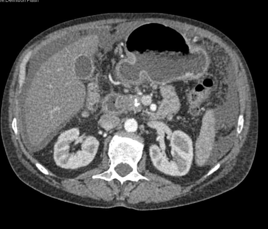 Adenocarcinoma Pancreas with carcinomatosis - CTisus CT Scan