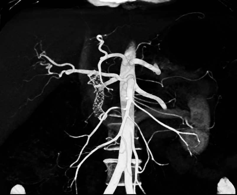 Invasive Adenocarcinoma Head of the Pancreas with Local Spread and Common Bile Duct (CBD) Stent - CTisus CT Scan