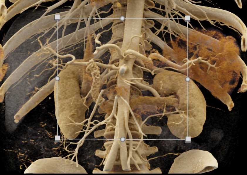 Invasive Adenocarcinoma Head of the Pancreas with Local Spread and Common Bile Duct (CBD) Stent - CTisus CT Scan