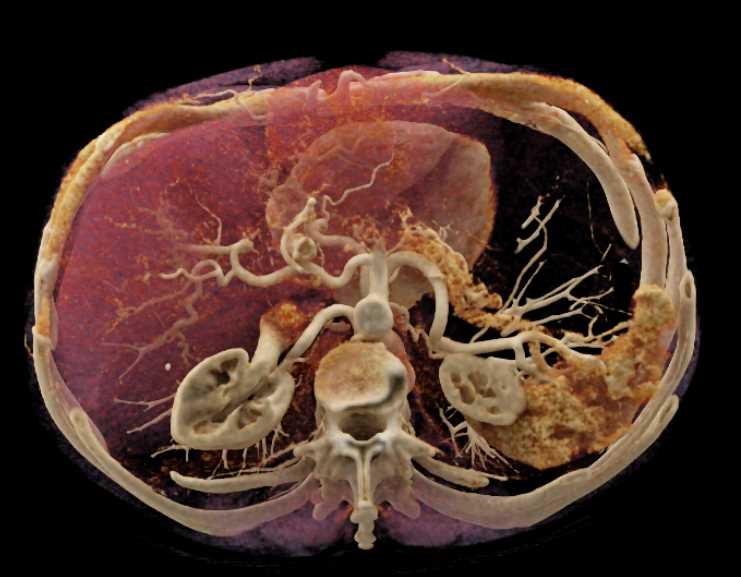 Pancreatic Adenocarcinoma with Cinematic Rendering - CTisus CT Scan