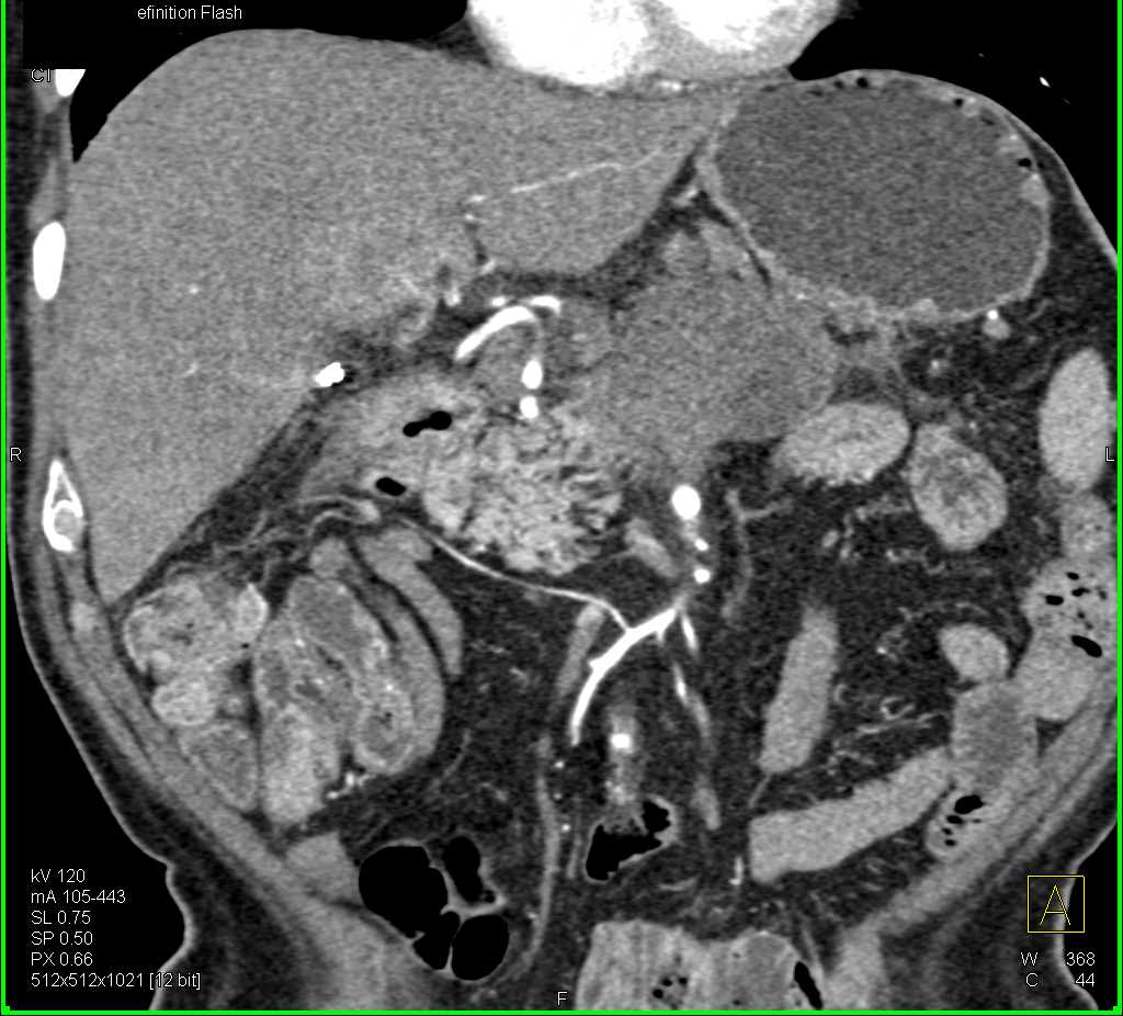 Pancreatic Adenocarcinoma with Vascular Encasement - CTisus CT Scan