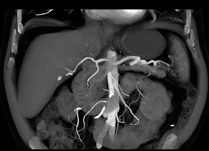 Intraductal Papillary Mucinous Neoplasm (IPMN) Tail of the Pancreas - CTisus CT Scan