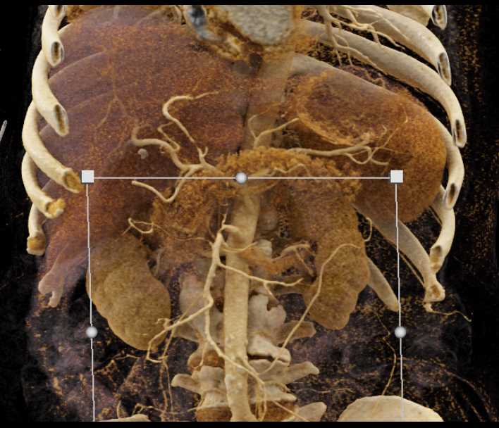 Encased Superior Mesenteric Artery (SMA) in Pancreatic Cancer - CTisus CT Scan