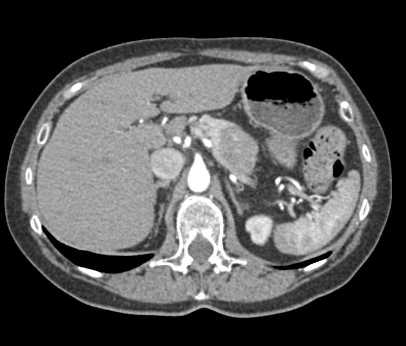 Autoimmune Pancreatitis (AIP) - CTisus CT Scan