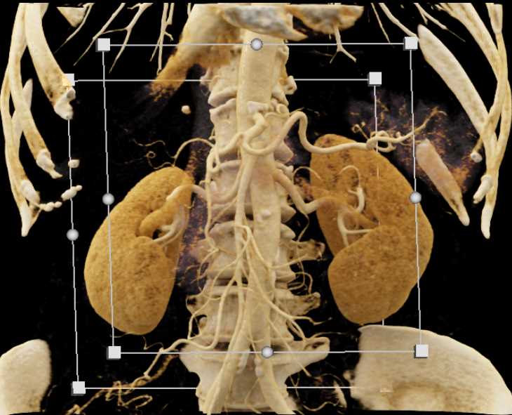 Autoimmune Pancreatitis (AIP) - CTisus CT Scan