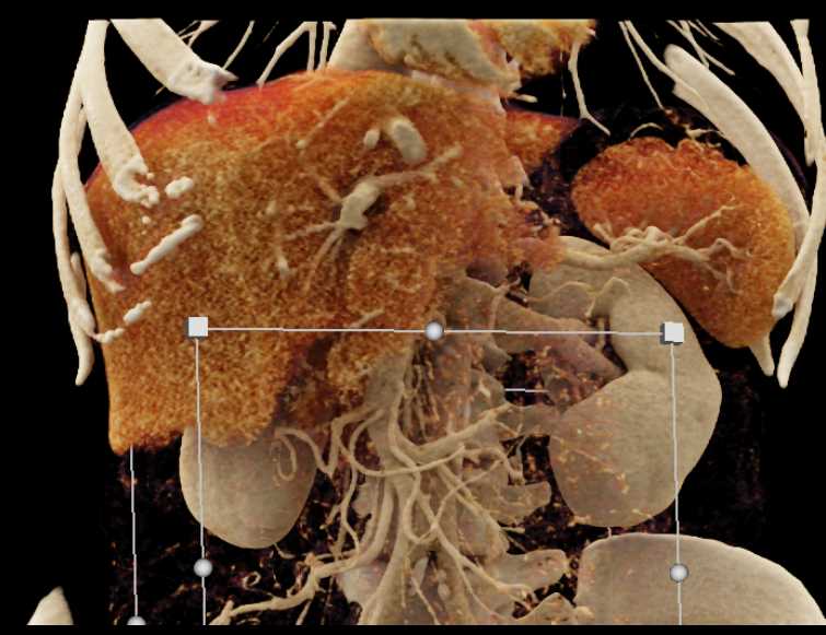 Pancreatic Cancer with Cinematic Rendering - CTisus CT Scan