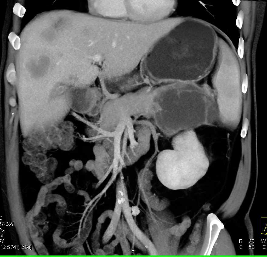 Carcinoma of the Tail of the Pancreas with Liver Metastases - CTisus CT Scan