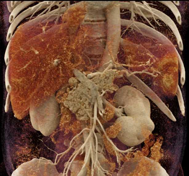 Carcinoma of the Tail of the Pancreas with Liver Metastases with Cinematic Rendering - CTisus CT Scan