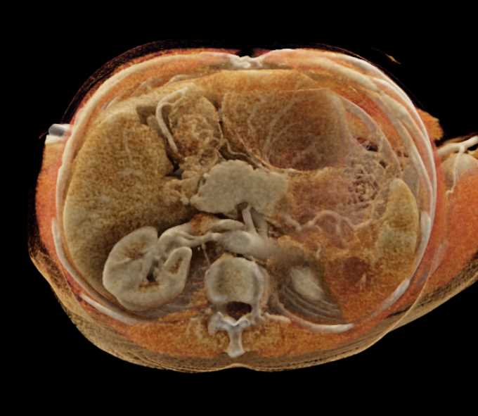 Carcinoma of the Tail of the Pancreas with Liver Metastases with Cinematic Rendering - CTisus CT Scan