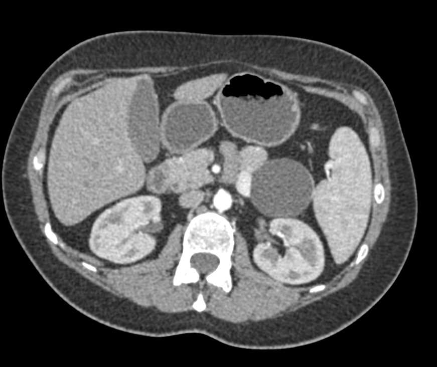 Mucinous Cystic Neoplasm Pancreas (MCN) - CTisus CT Scan