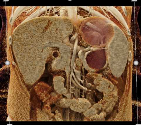 Mucinous Cystic Neoplasm Pancreas (MCN) with Cinematic Rendering - CTisus CT Scan