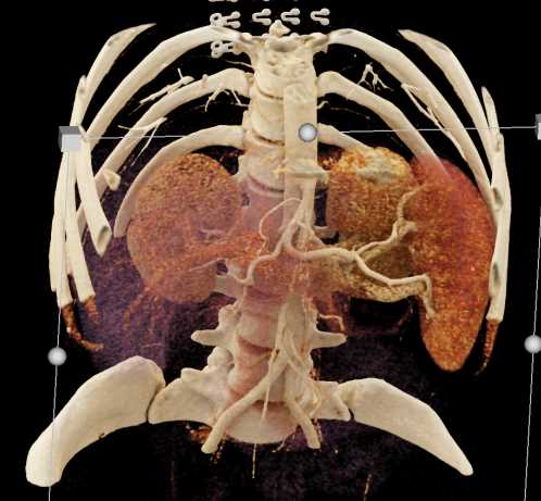 Mucinous Cystic Neoplasm Pancreas (MCN) - CTisus CT Scan