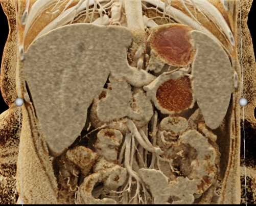 Mucinous Cystic Neoplasm Pancreas (MCN) - CTisus CT Scan