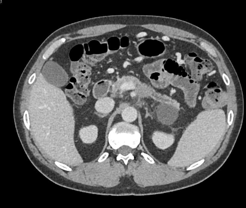 Carcinoma Body of the Pancreas - CTisus CT Scan