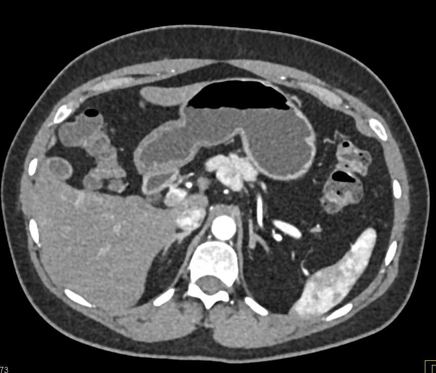 Neuroendocrine Tumor Pancreas - CTisus CT Scan