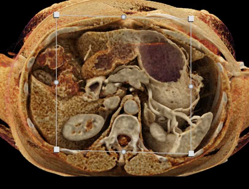 Carcinoma Pancreas with Atrophy of the Tail - CTisus CT Scan