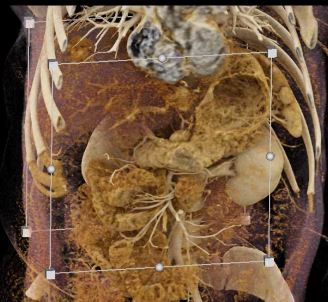 Carcinoma Pancreas with Atrophy of the Tail - CTisus CT Scan