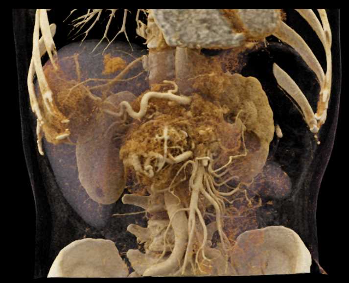 Neuroendocrine Tumor Pancreas with Liver Metastases - CTisus CT Scan