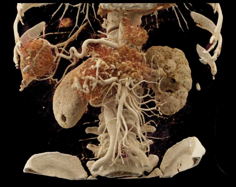 Neuroendocrine Tumor Pancreas with Liver Metastases - CTisus CT Scan