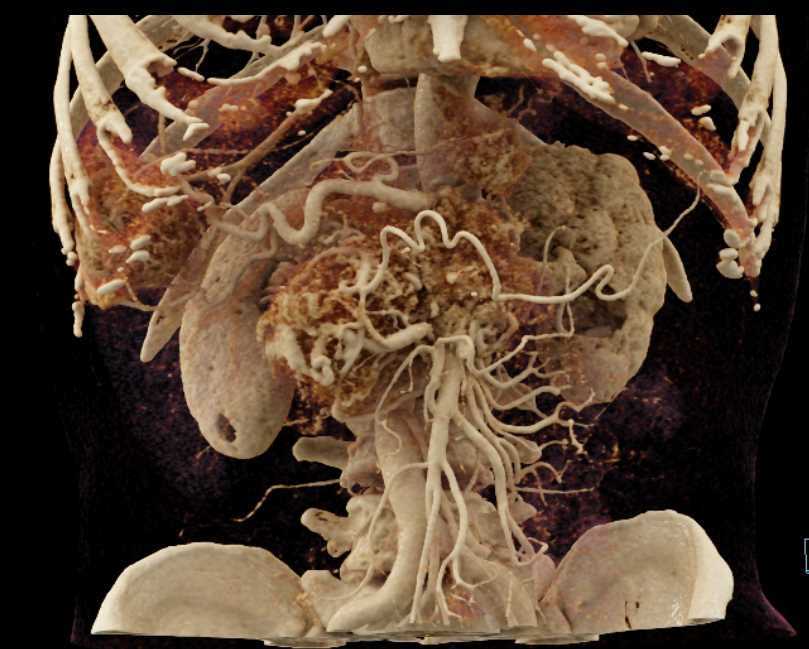 Neuroendocrine Tumor Pancreas with Liver Metastases - CTisus CT Scan