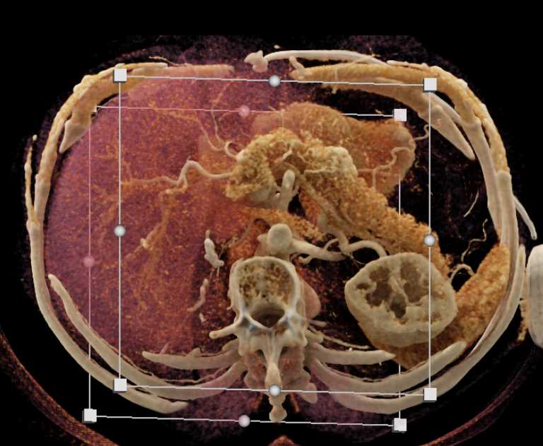 Neuroendocrine Tumor Pancreas - CTisus CT Scan