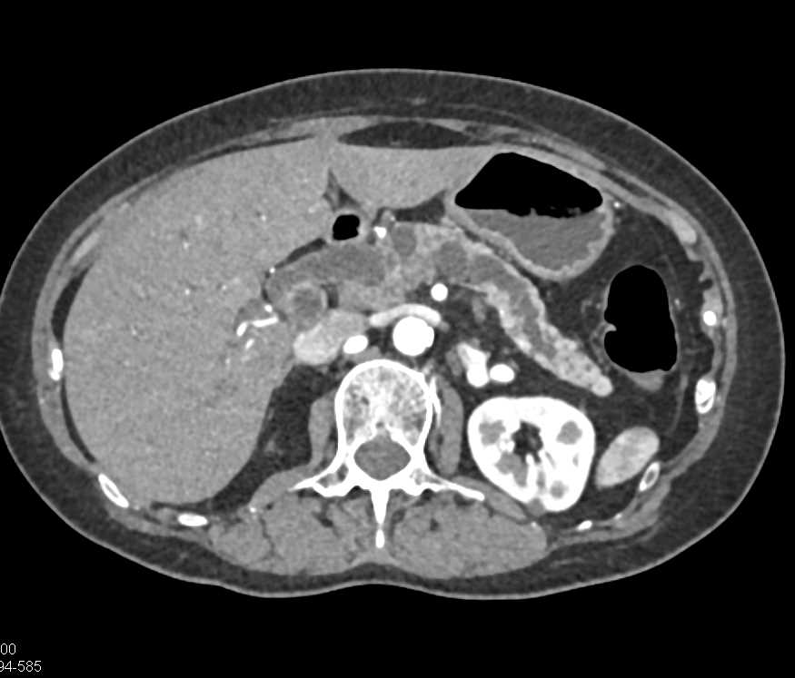 Subtle Pancreatic Cancer Obstructs the Pancreatic Duct - CTisus CT Scan