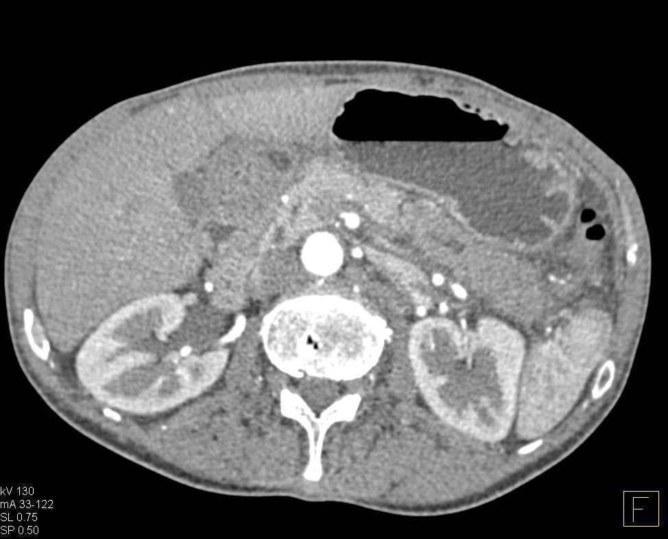 Carcinoma Body of the Pancreas with Dilated Pancreatic Duct - CTisus CT Scan