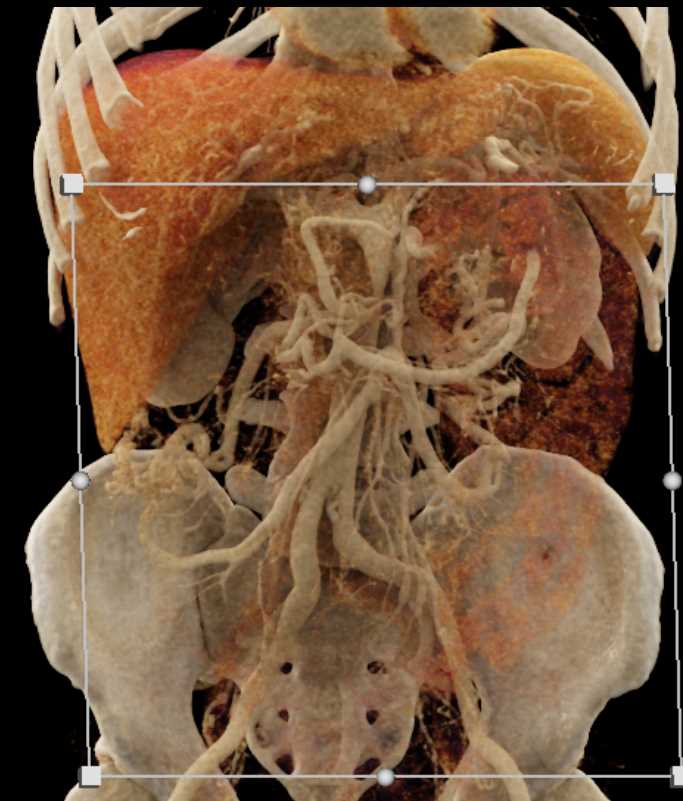 Complex Pancreatic Mass with Vascular Involvement - CTisus CT Scan