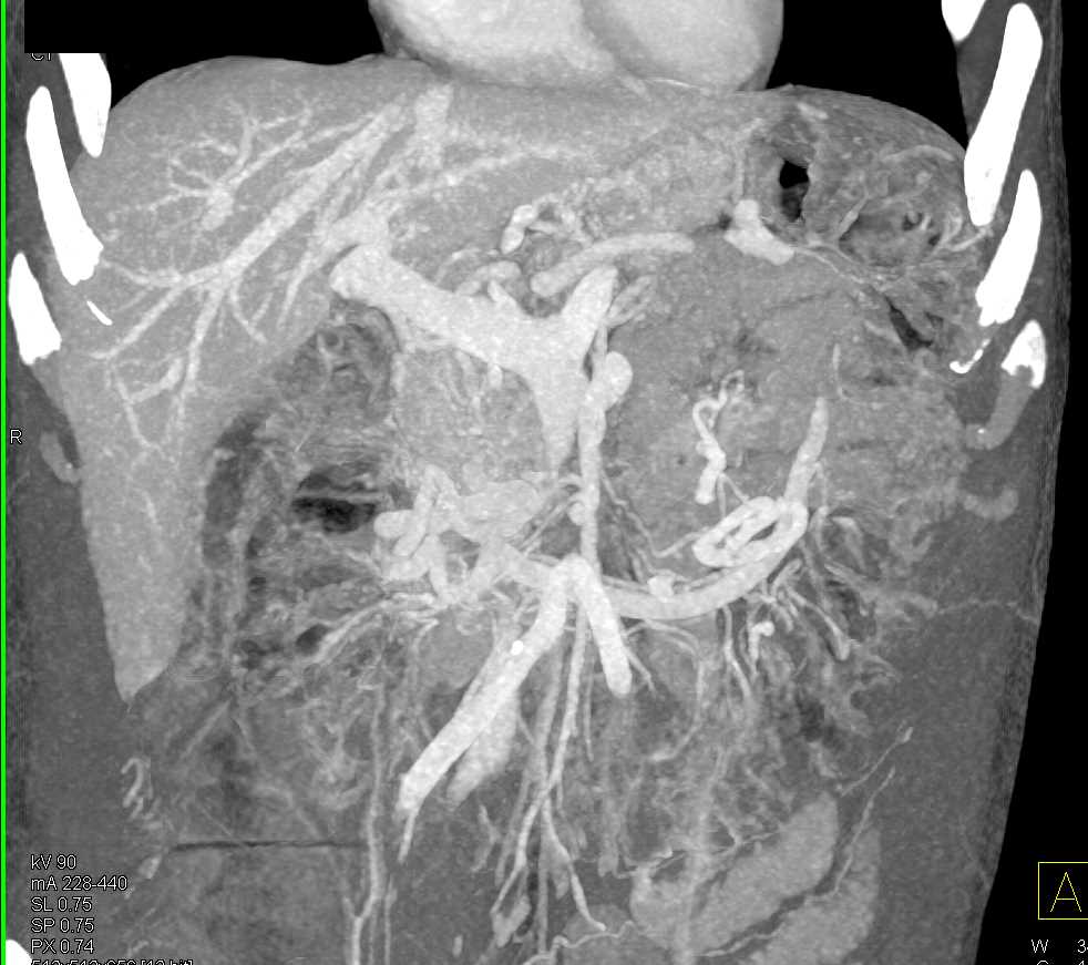 Pancreatic Adenocarcinoma with Vascular Invasion - CTisus CT Scan