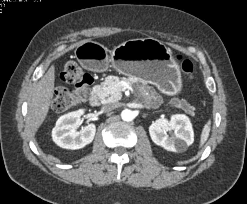 Carcinoma of the Pancreas Arises froom a Main Duct Intraductal Papillary Mucinous Neoplasm (IPMN) - CTisus CT Scan