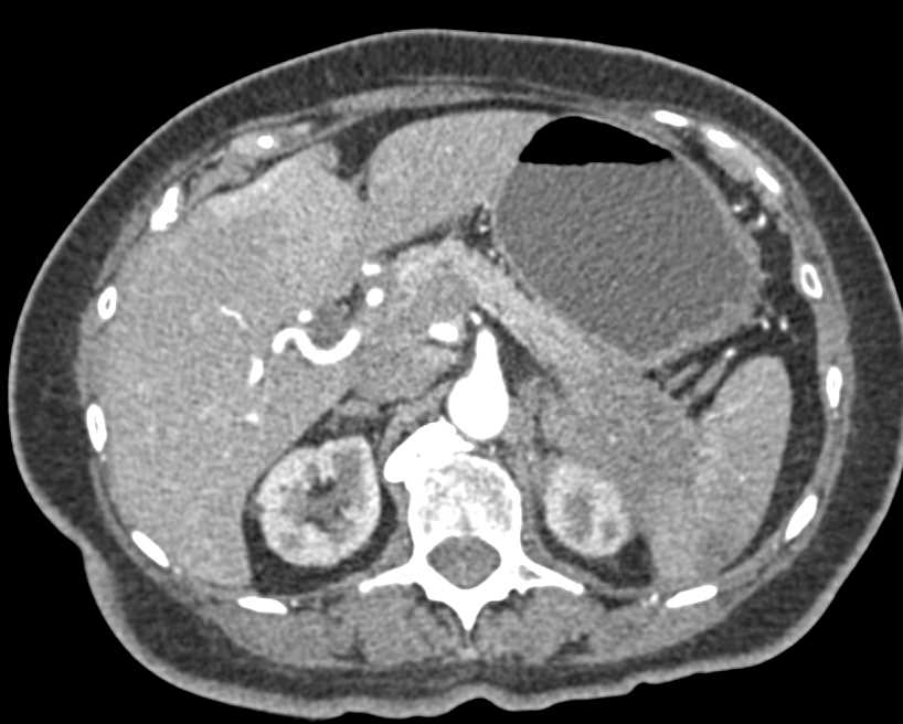 Invasive Pancreatic Adenocarcinoma - CTisus CT Scan