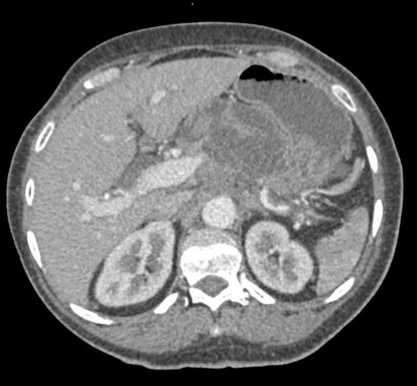 Acute Pancreatitis - CTisus CT Scan