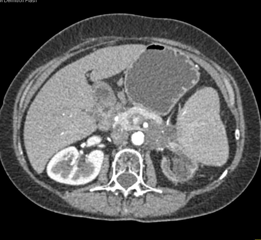 Invasive Carcinoma Tail of Pancreas - CTisus CT Scan