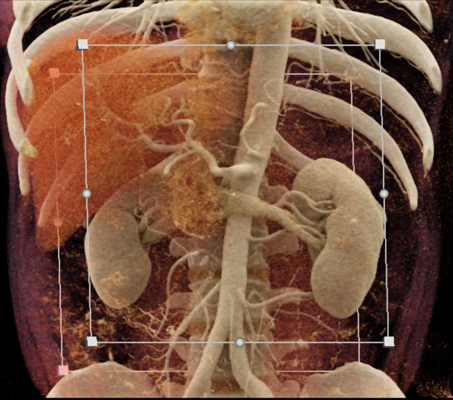 SPEN Tumor Pancreas - CTisus CT Scan