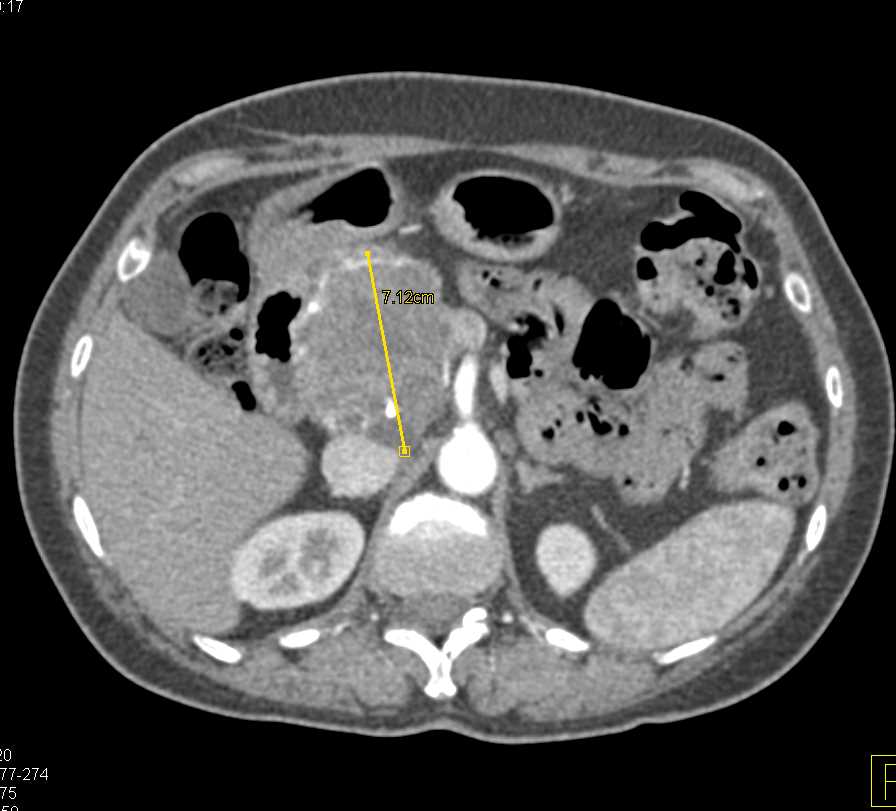 Serous Cystadenoma - CTisus CT Scan