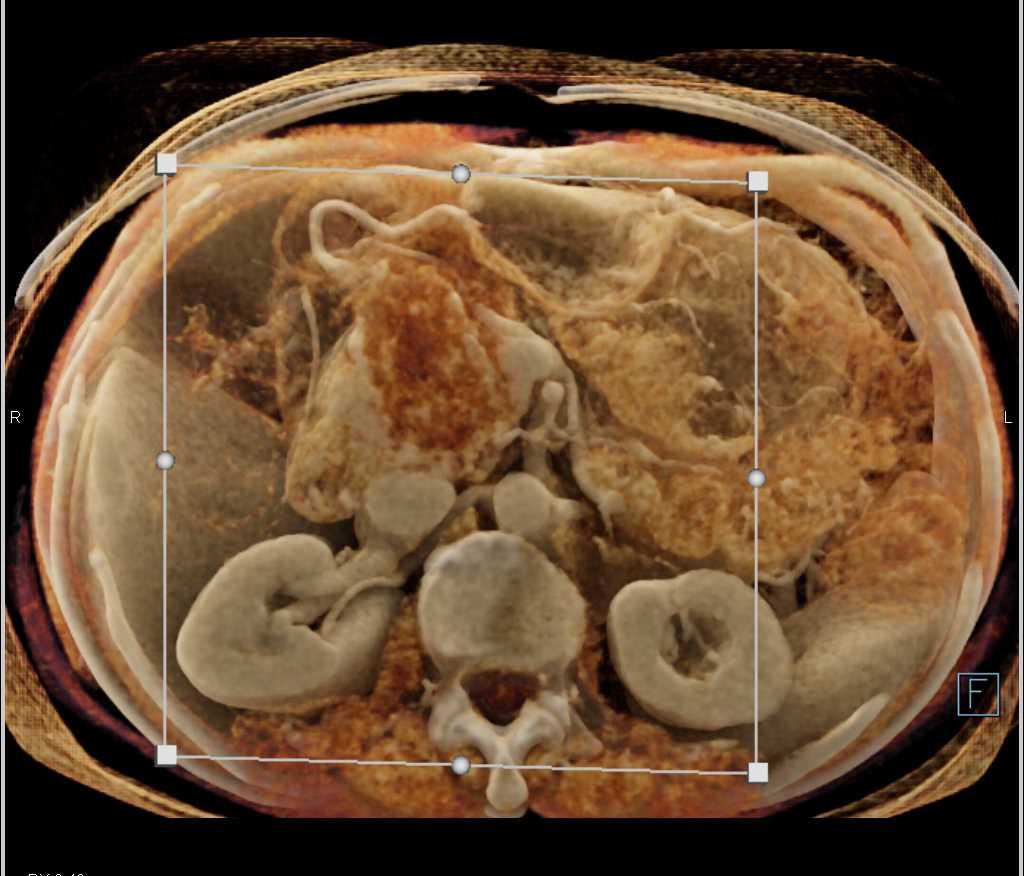 Serous Cystadenoma - CTisus CT Scan