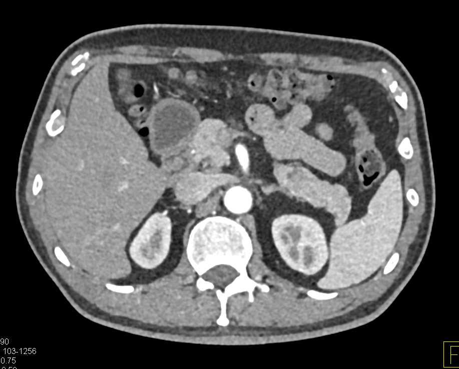 Subtle Carcinoma at Junction of Body and Tail of Pancreas - CTisus CT Scan