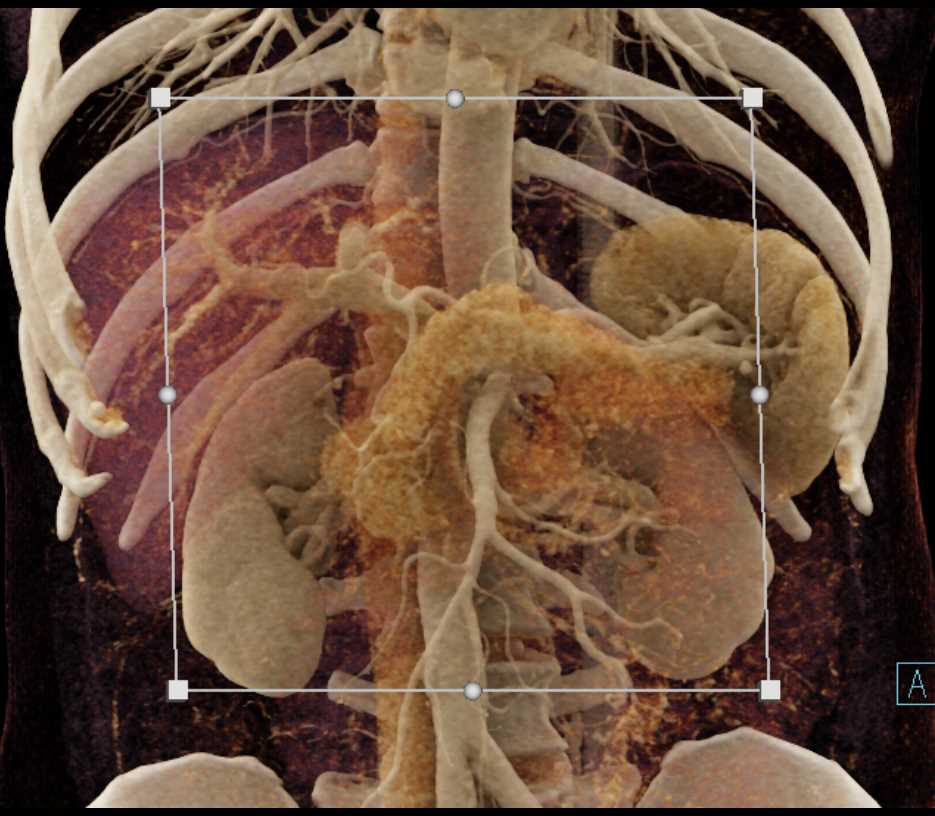 Subtle Carcinoma at Junction of Body and Tail of Pancreas - CTisus CT Scan