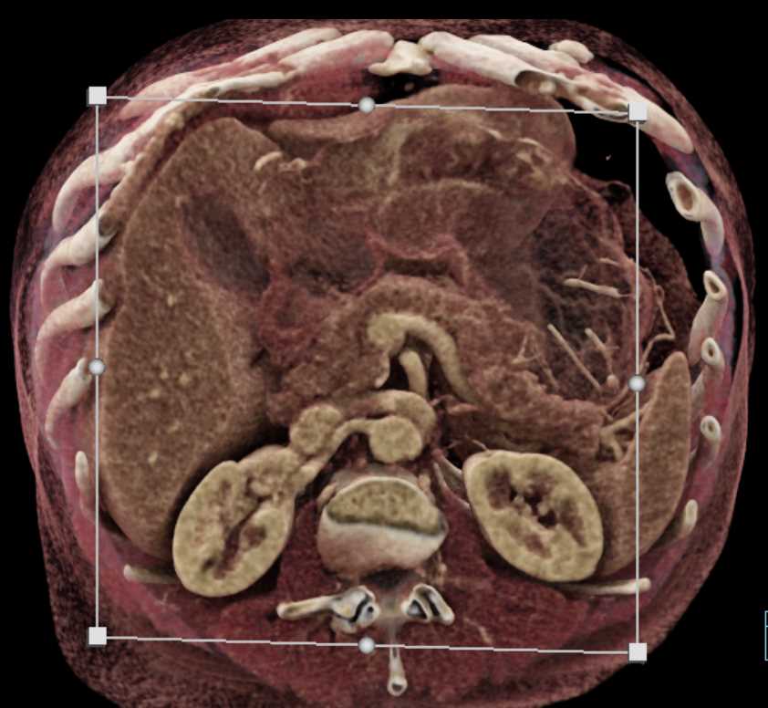 Carcinoma Tail of the Pancreas - CTisus CT Scan