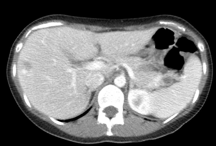 Carcinoma Tail of Pancreas - CTisus CT Scan