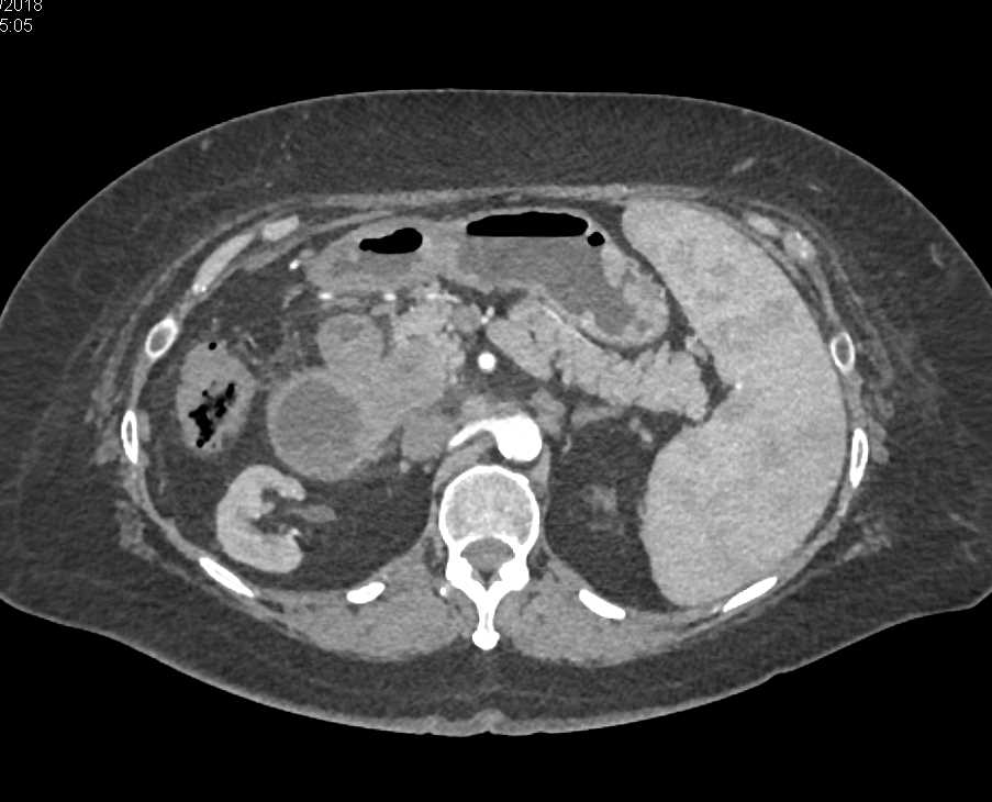 Lymphoma Involves the Head of the Pancreas - CTisus CT Scan