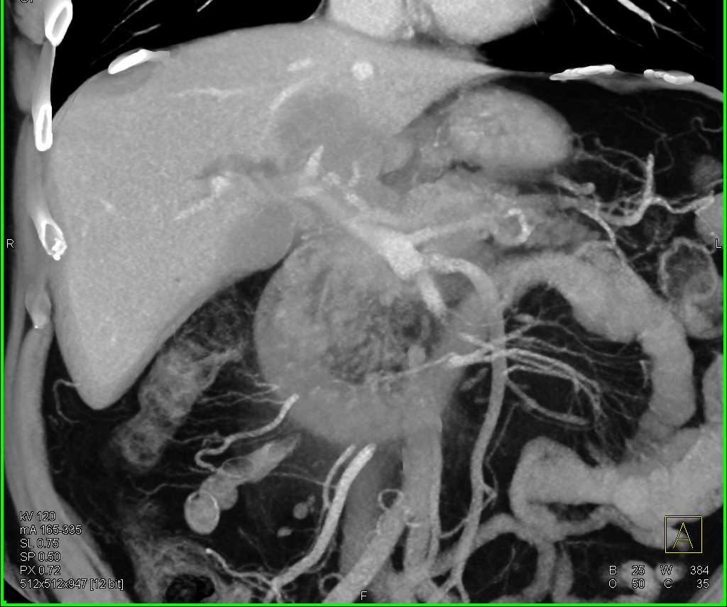 Pancreatic Cancer Encases the Celiac and SMA - CTisus CT Scan