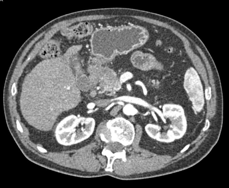 Pancreatic Adenocarcinoma - CTisus CT Scan