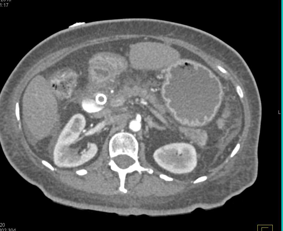 Pancreatic Cancer with CBD Stent - CTisus CT Scan