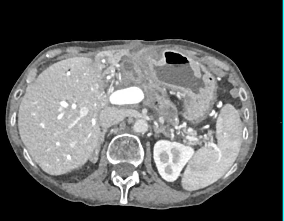 Recurrent Pancreatic Cancer Post Whipples - CTisus CT Scan