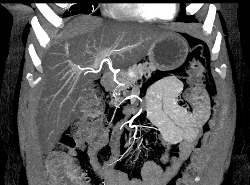 1 cm Pancreatic Neuroendocrine Tumor (PNET) Body of Pancreas - CTisus CT Scan